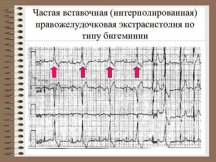 Частая вставочная (интерполированная) правожелудочковая экстрасистолия по типу бигеминии. . 
