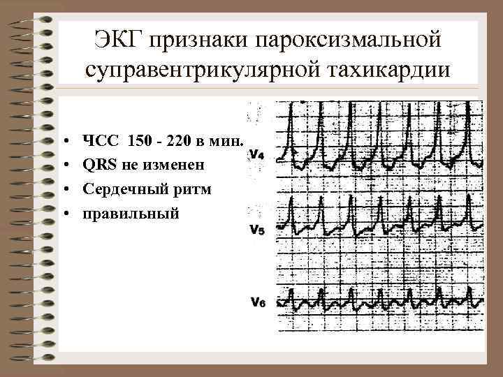 ЭКГ признаки пароксизмальной суправентрикулярной тахикардии • • ЧСС 150 - 220 в мин. QRS