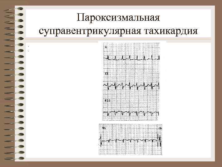 Пароксизмальная суправентрикулярная тахикардия. . 