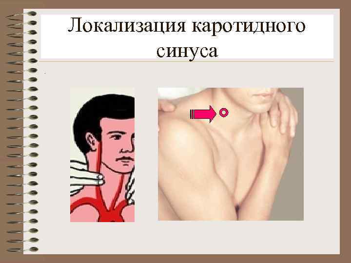Локализация каротидного синуса. 