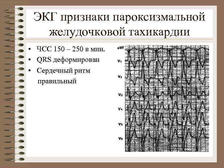 ЭКГ признаки пароксизмальной желудочковой тахикардии • ЧСС 150 – 250 в мин. • QRS