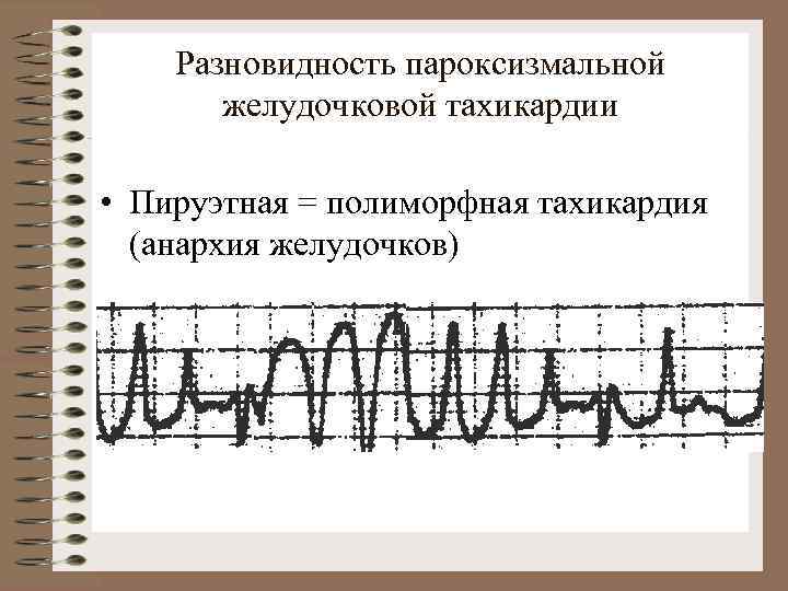 При возникновении пароксизма устойчивой желудочковой тахикардии на фоне инфаркта миокарда показано