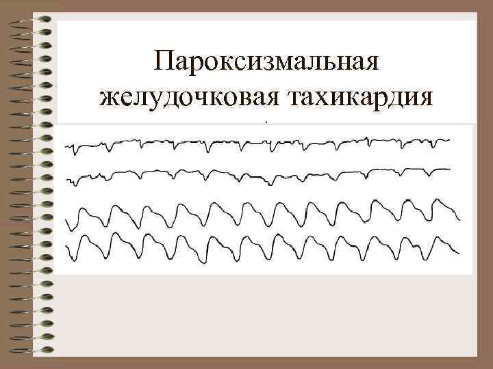 Пароксизмальная желудочковая тахикардия. 
