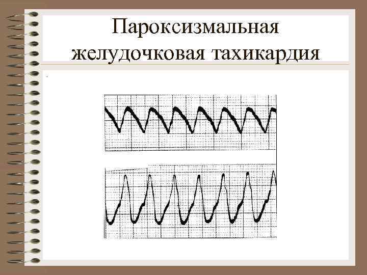 Пароксизмальная желудочковая тахикардия. 