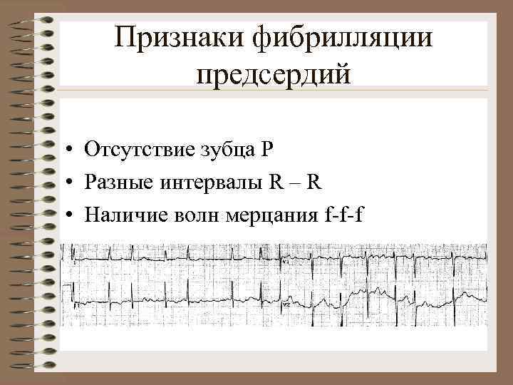 Признаки фибрилляции предсердий • Отсутствие зубца Р • Разные интервалы R – R •