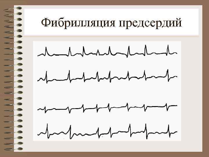 Фибрилляция предсердий 