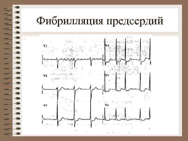 Фибрилляция предсердий. 
