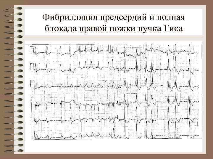 Фибрилляция предсердий и полная блокада правой ножки пучка Гиса. 