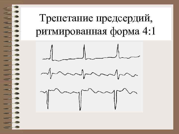 Трепетание предсердий, ритмированная форма 4: 1 