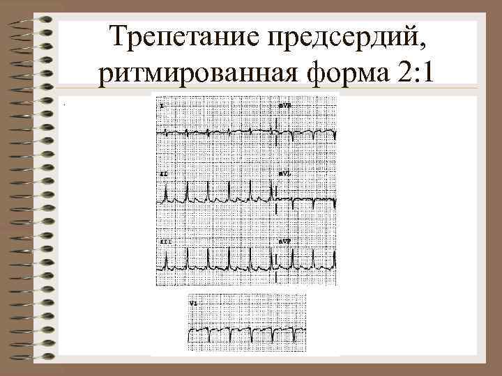 Трепетание предсердий, ритмированная форма 2: 1. 