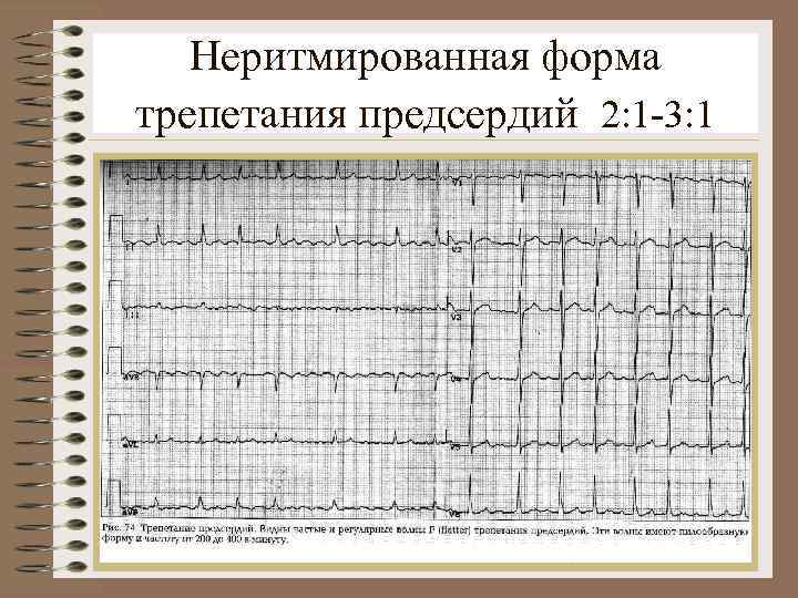 Неритмированная форма трепетания предсердий 2: 1 -3: 1 