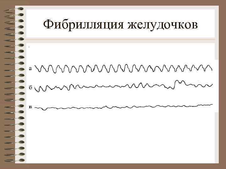 Фибрилляция желудочков. 