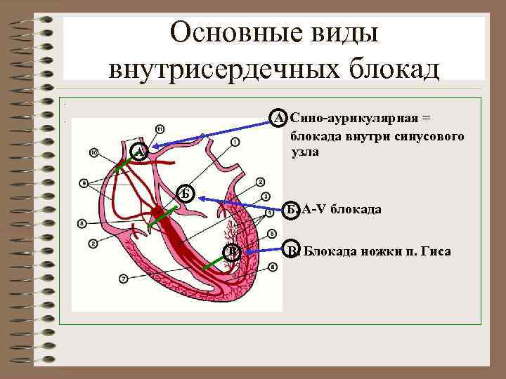 Основные виды внутрисердечных блокад. А. Сино-аурикулярная = блокада внутри синусового узла . А Б