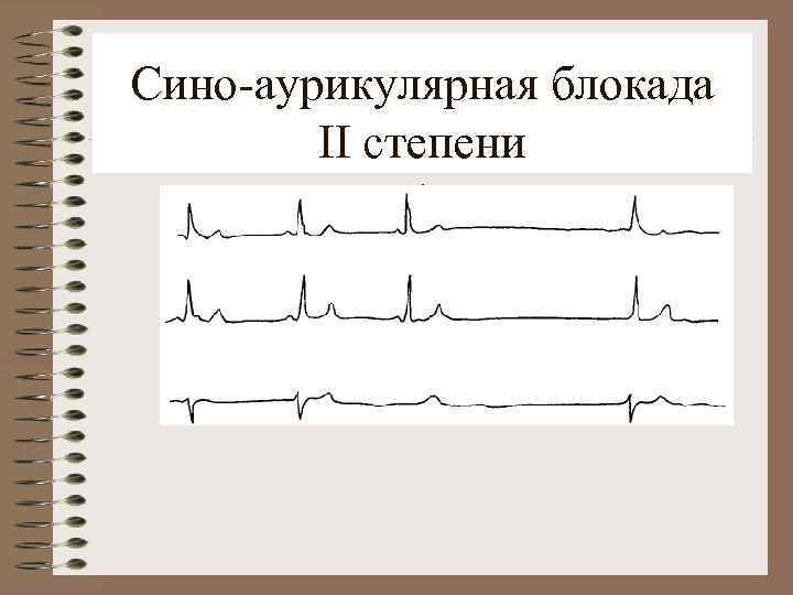 Сино-аурикулярная блокада II степени. 