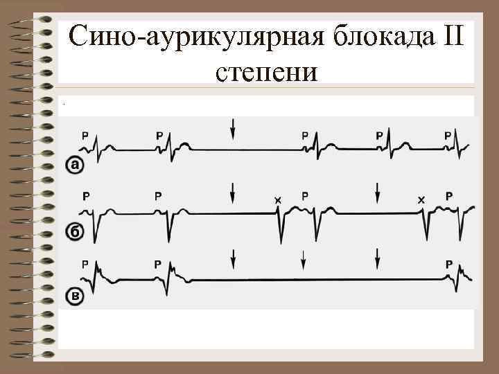 Сино-аурикулярная блокада II степени. 