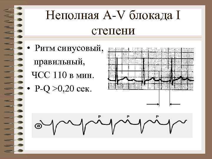 Неполная A-V блокада I степени • Ритм синусовый, правильный, ЧСС 110 в мин. •