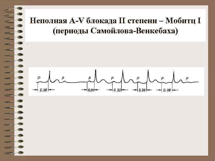 Неполная A-V блокада II степени – Мобитц I (периоды Самойлова-Венкебаха). 