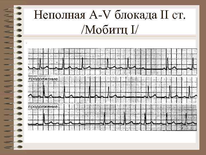 Неполная A-V блокада II ст. /Мобитц I/. 