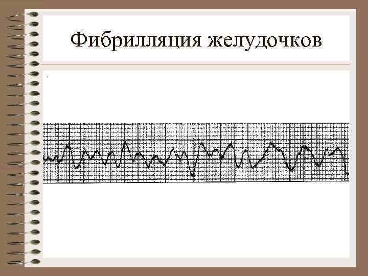 Фибрилляция желудочков. 