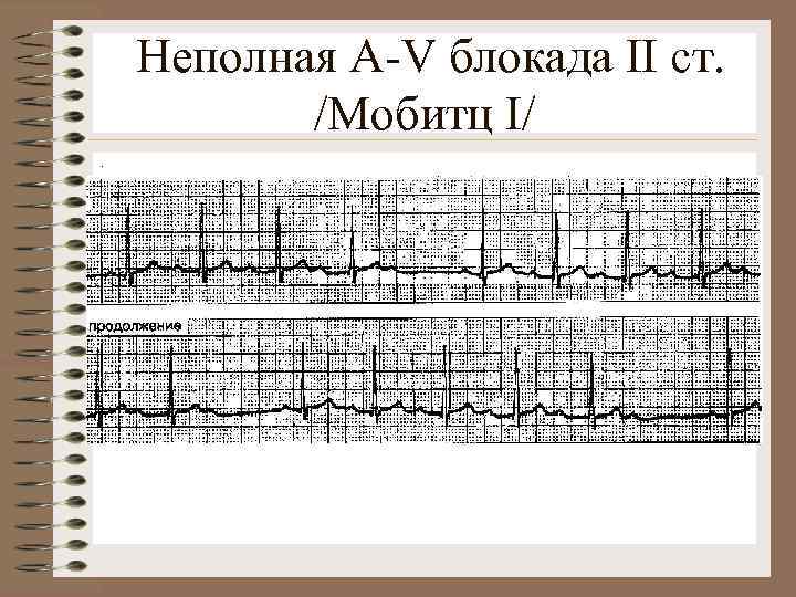 Неполная A-V блокада II ст. /Мобитц I/. 