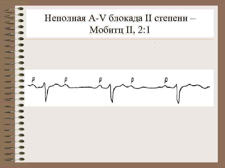 Неполная A-V блокада II степени – Мобитц II, 2: 1. 
