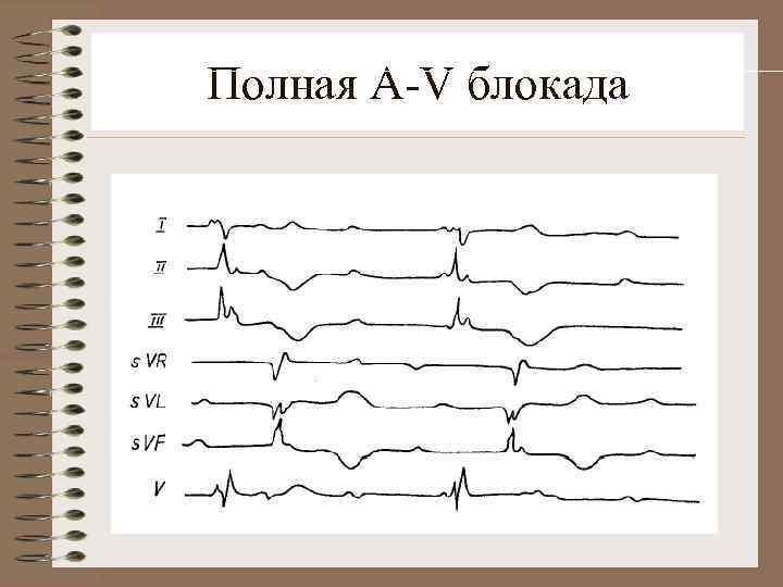 Полная A-V блокада 