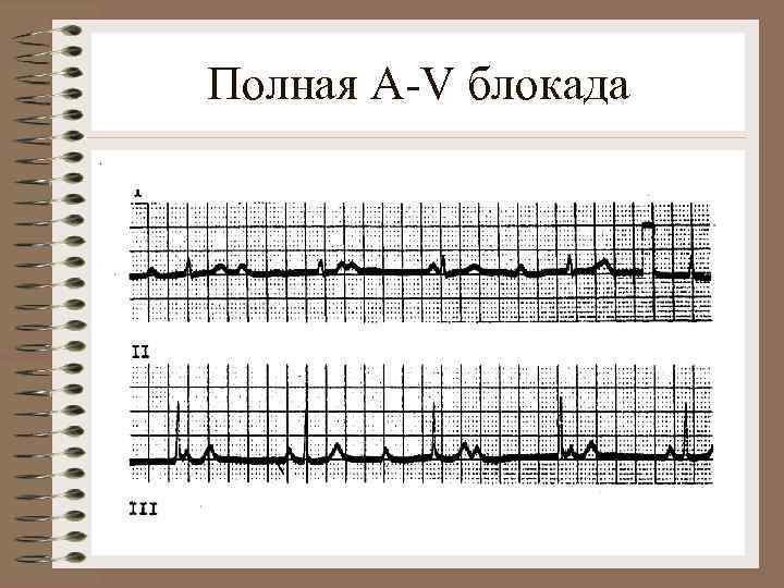 Полная A-V блокада. 