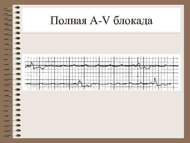 Полная A-V блокада 