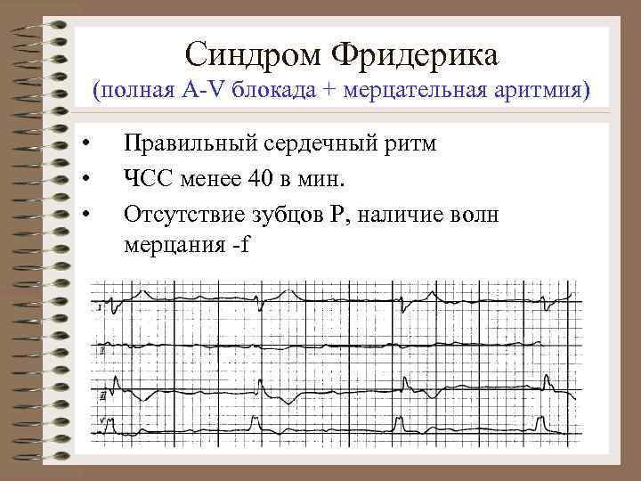 Синдром Фридерика (полная A-V блокада + мерцательная аритмия) • • • Правильный сердечный ритм