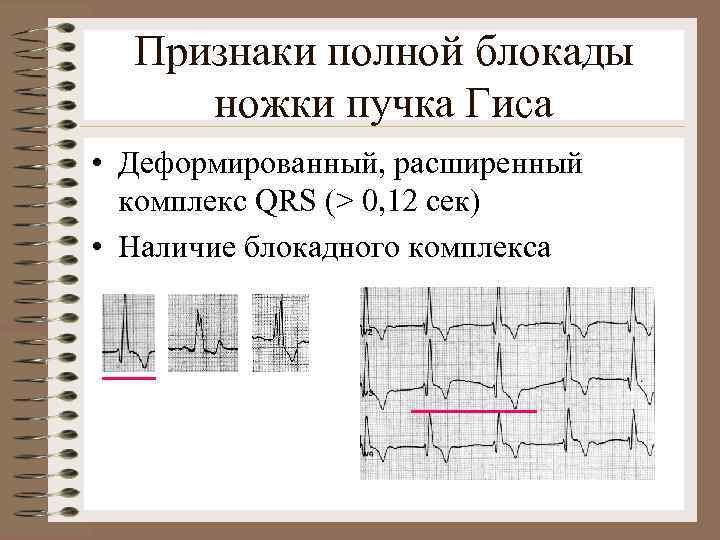 Признаки полной блокады ножки пучка Гиса • Деформированный, расширенный комплекс QRS (> 0, 12