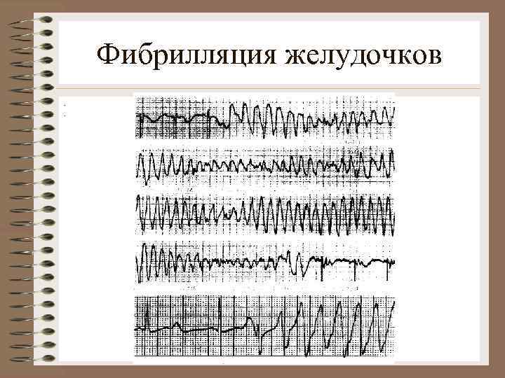 Фибрилляция желудочков. . 