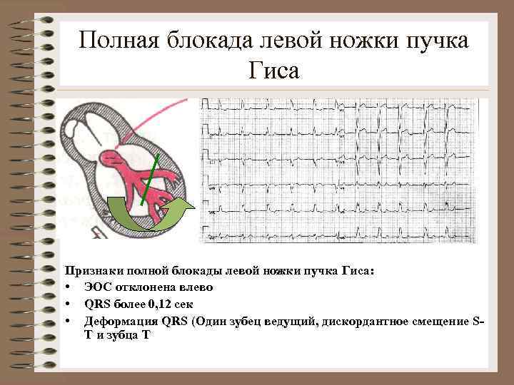 Полная блокада левой ножки пучка Гиса Признаки полной блокады левой ножки пучка Гиса: •