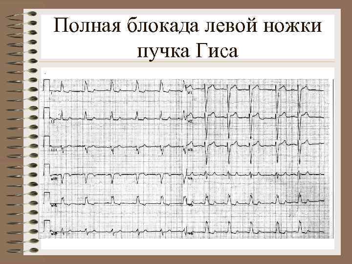 Полная блокада левой ножки пучка Гиса. 