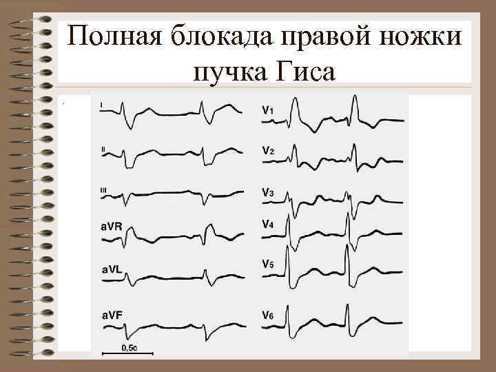 Полная блокада правой ножки пучка Гиса. 