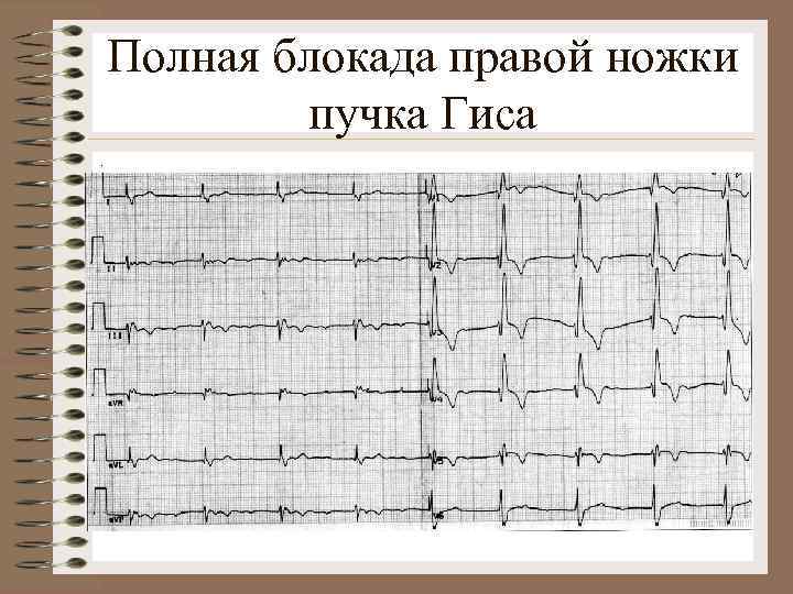 Полная блокада правой ножки пучка Гиса. 