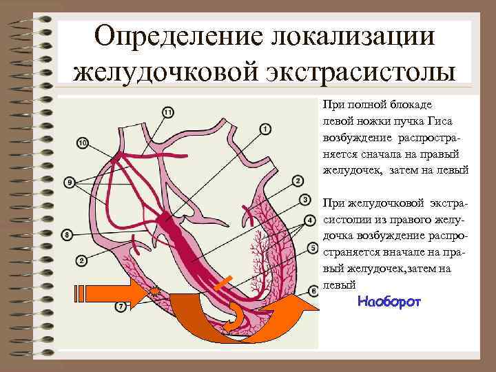 Определение локализации желудочковой экстрасистолы. При полной блокаде левой ножки пучка Гиса возбуждение распространяется сначала