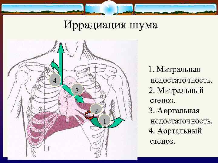Иррадиация шума 4 3 2 1 1. Митральная недостаточность. 2. Митральный стеноз. 3. Аортальная