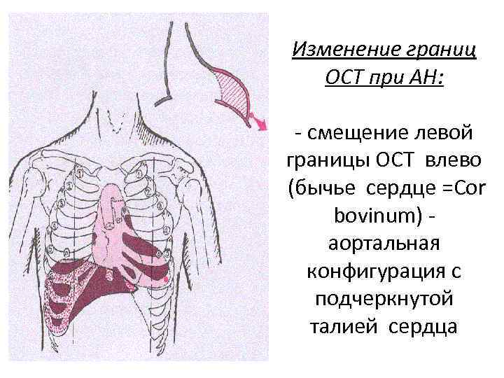 Границы расширены влево. Cor Bovinum конфигурация сердца. Бычье сердце конфигурация сердца. Границы сердца при аортальной конфигурации. Границы сердца при аортальных пороках.