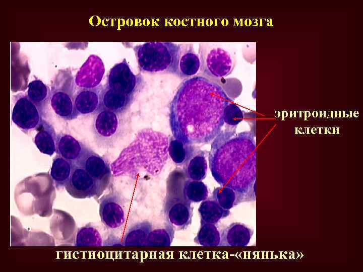 Островок костного мозга эритроидные клетки гистиоцитарная клетка- «нянька» 