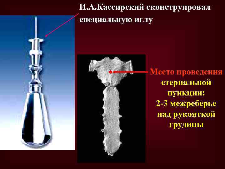 И. А. Кассирский сконструировал специальную иглу Место проведения стернальной пункции: 2 -3 межреберье над
