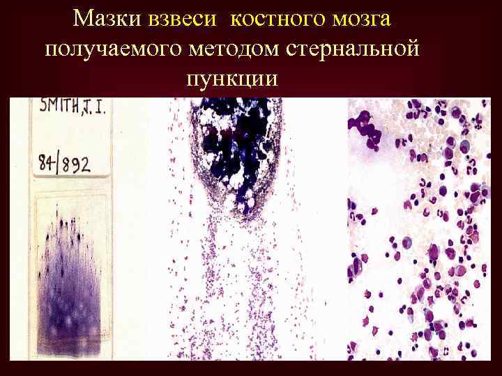 Мазки взвеси костного мозга получаемого методом стернальной пункции 