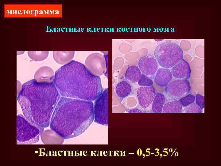 миелограмма Бластные клетки костного мозга • Бластные клетки – 0, 5 -3, 5% 
