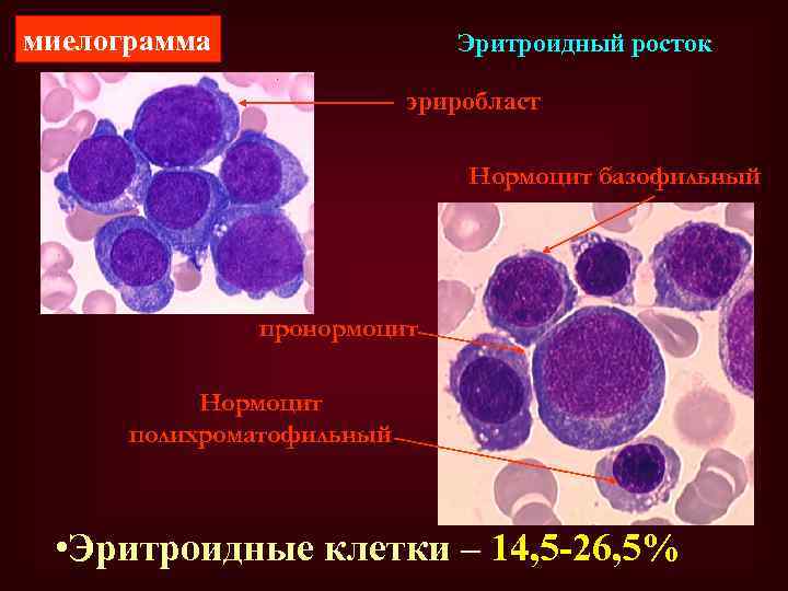 миелограмма Эритроидный росток эриробласт Нормоцит базофильный пронормоцит Нормоцит полихроматофильный • Эритроидные клетки – 14,