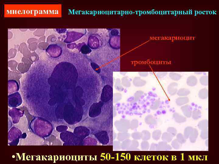 миелограмма Мегакариоцитарно-тромбоцитарный росток мегакариоцит тромбоциты • Мегакариоциты 50 -150 клеток в 1 мкл 