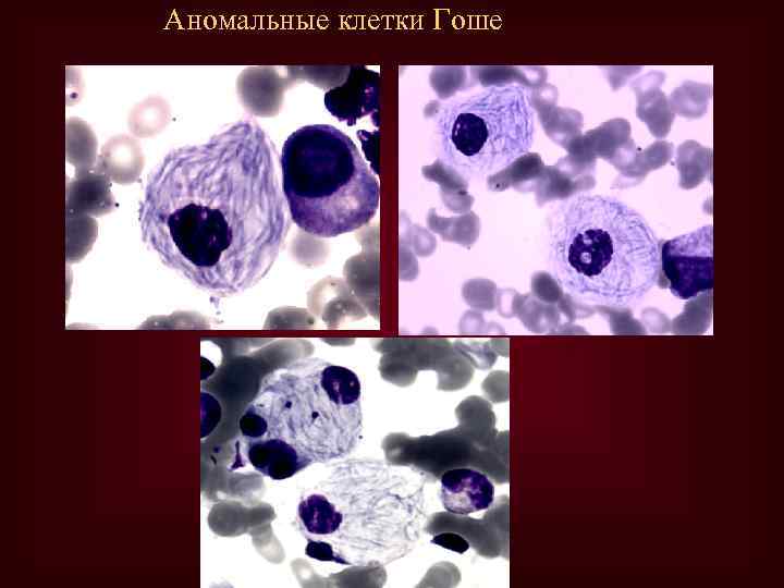 Аномальные клетки Гоше 