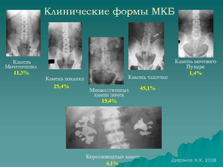 Клинические формы МКБ Камень Мочеточника 11, 3% Камень лоханки 25, 4% Камень чашечки Множественные