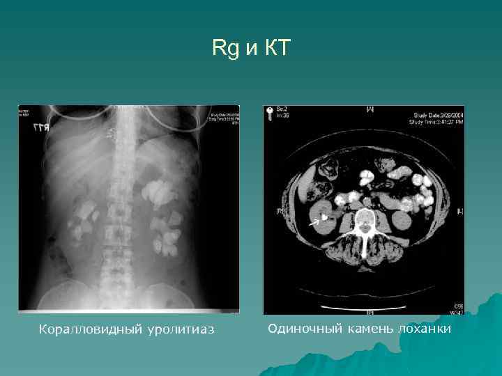 Rg и КТ Коралловидный уролитиаз Одиночный камень лоханки 