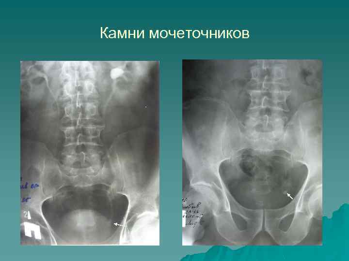 Камни мочеточников 