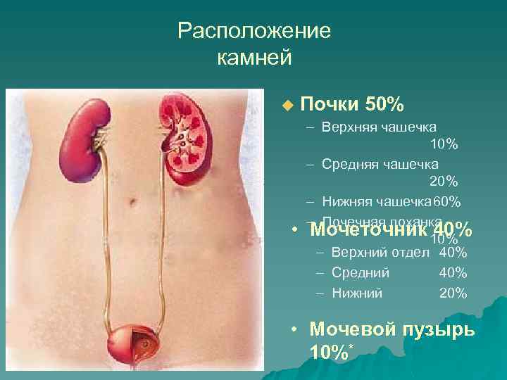 Расположение камней u • Почки 50% – Верхняя чашечка 10% – Средняя чашечка 20%