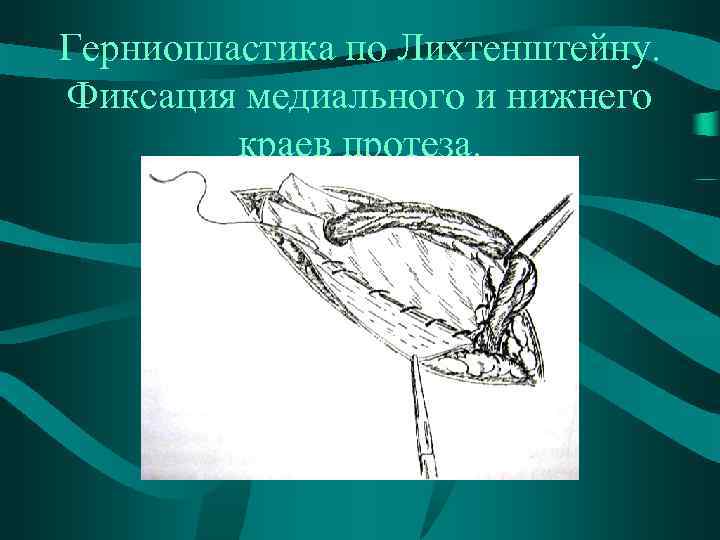 Герниопластика по Лихтенштейну. Фиксация медиального и нижнего краев протеза. 